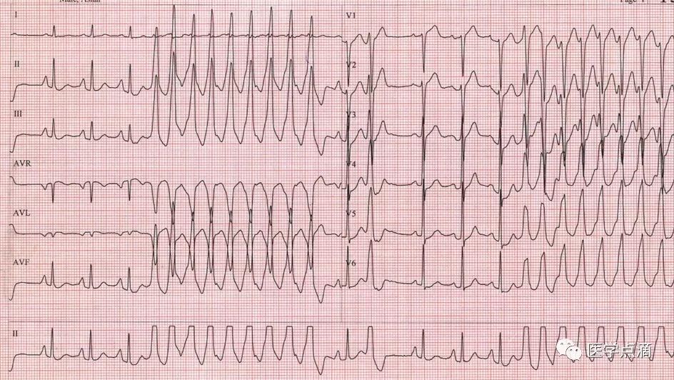 心电图总是记不住？这些基础知识一定要掌握！