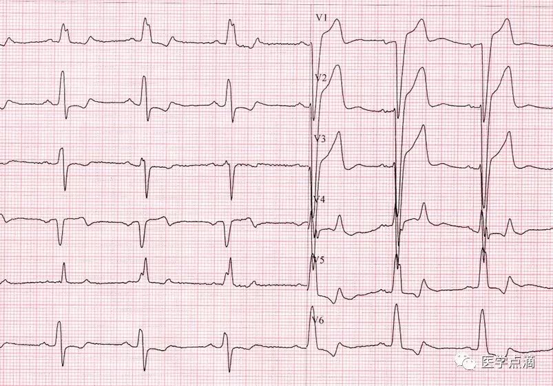 心电图总是记不住？这些基础知识一定要掌握！