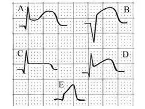 一文道尽『ST-T改变』的种种困惑！
