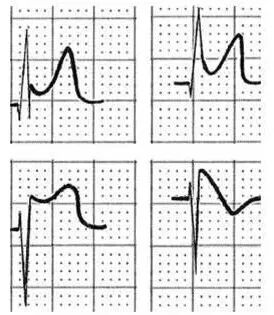 一文道尽『ST-T改变』的种种困惑！