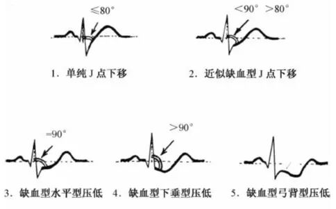 一文道尽『ST-T改变』的种种困惑！