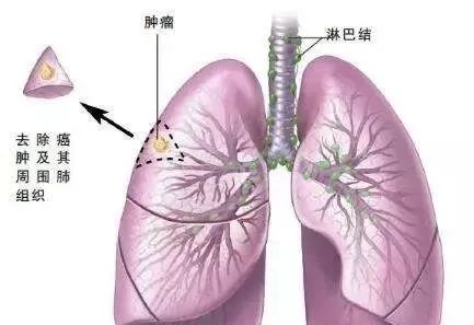 台湾长庚质子治 疗肺癌