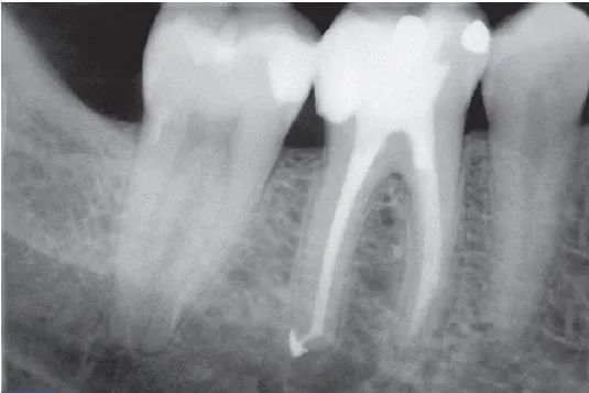 急性牙髓炎根尖周炎的应急处理，其实并没有那么简单