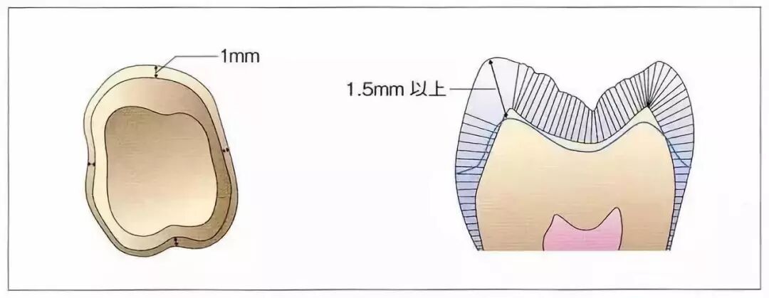 肩台制备时的注意事项！