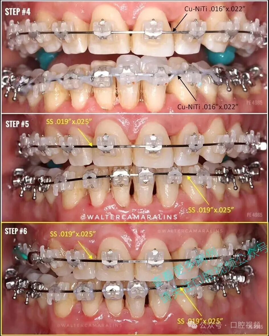 这样的正畸，该怎么收费