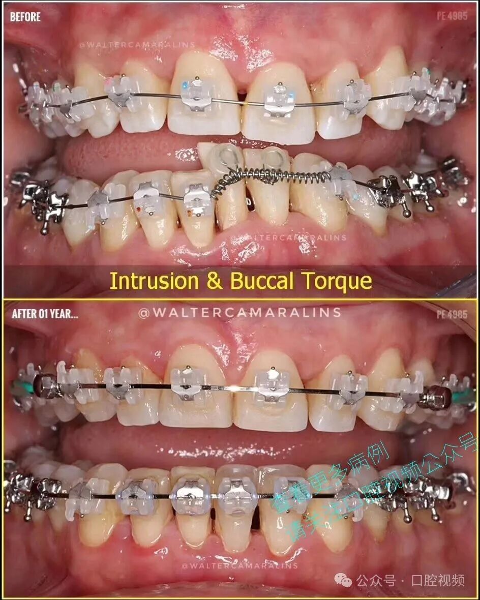 这样的正畸，该怎么收费