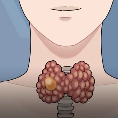 体检查出结节、囊肿、息肉，是不是癌症先兆？