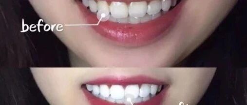 韩国黑科技牙膏！360度溶解陈年牙垢，比洗牙还干净9527倍！打kiss再也没压力！