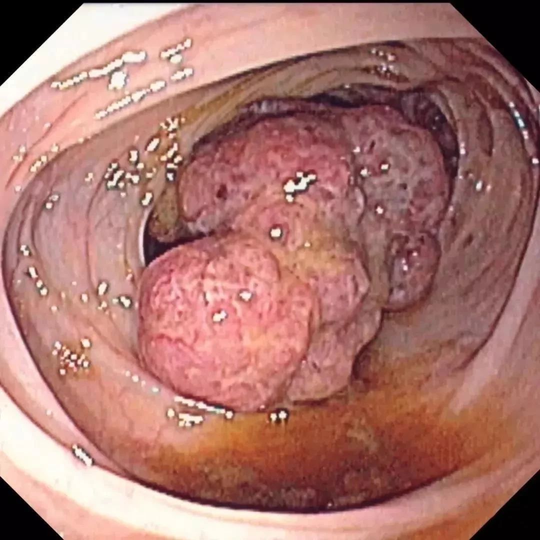 小心！这样的大便，可能是大肠癌来临！