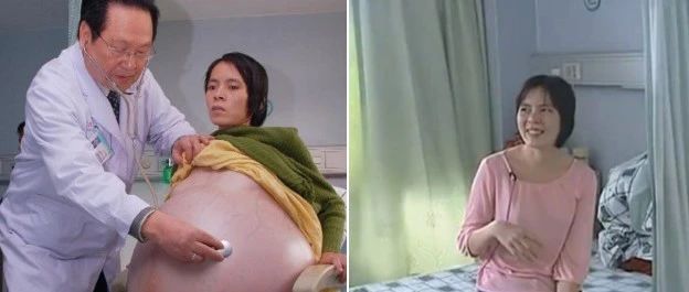 广东孕妈妈挺55公斤巨肚，怀孕11个月迟迟未生，检查才知肚中竟看不见孩子…