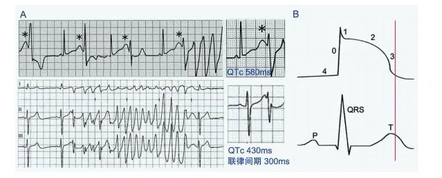 这些特征心电图改变，都是猝死的前兆