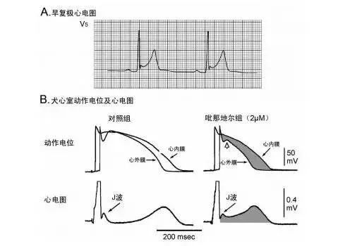 这些特征心电图改变，都是猝死的前兆