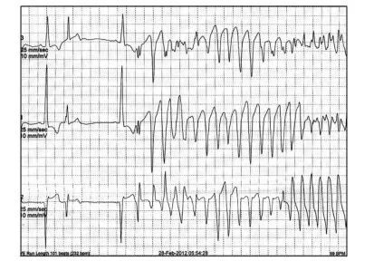 这些特征心电图改变，都是猝死的前兆