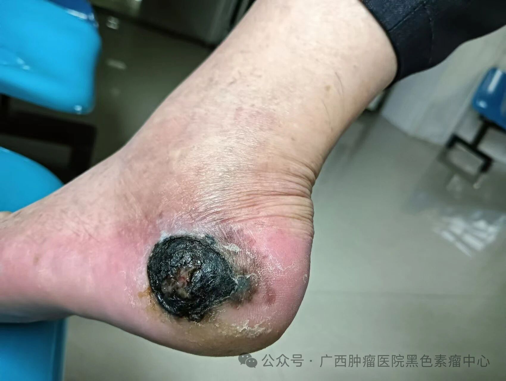 黑色素瘤治愈率揭秘：科学治疗与生存希望全解析，助你战胜病魔重获新生