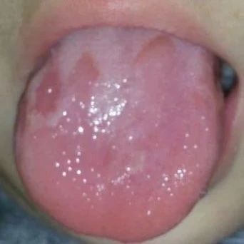 儿童的舌头容易出现的三种问题，哪一种需要手术治疗？