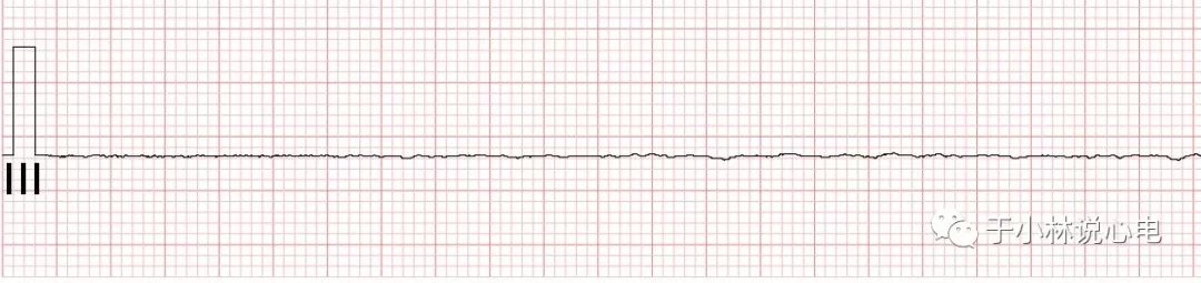 心电图如何报告死亡与濒死心电图​诊断