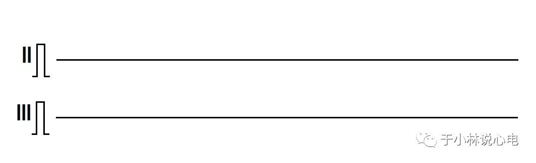 心电图如何报告死亡与濒死心电图​诊断