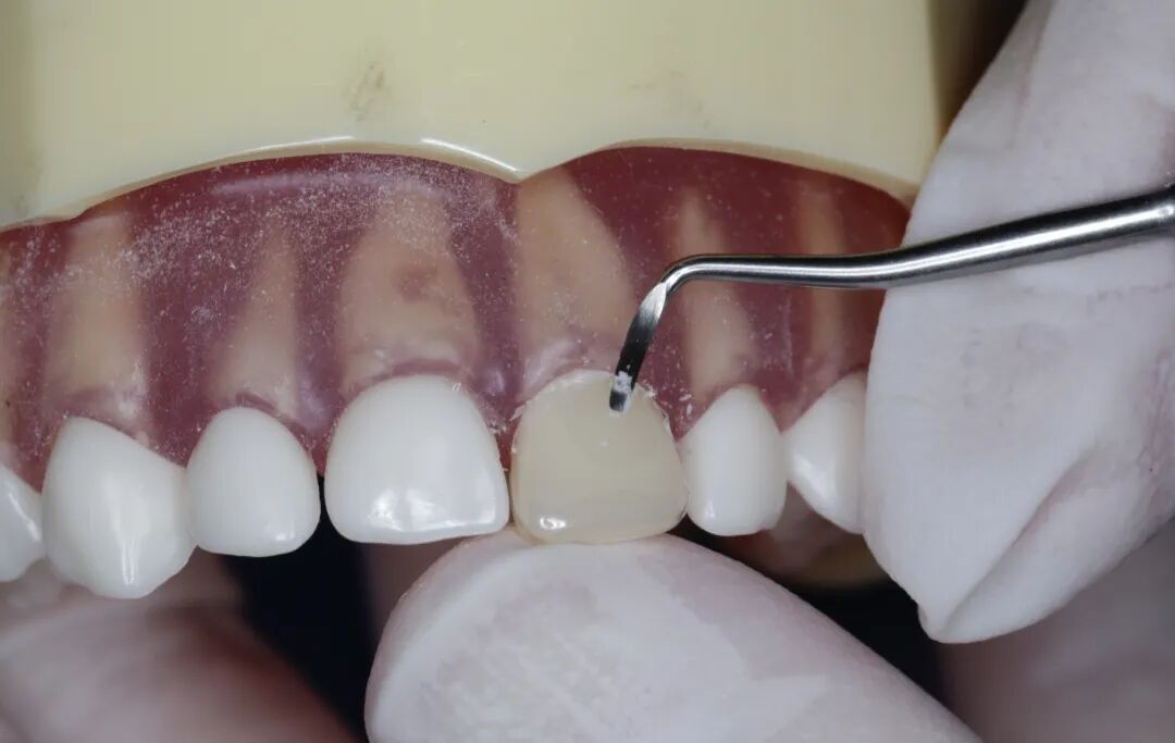 乳前牙透明冠的操作过程及技术要点
