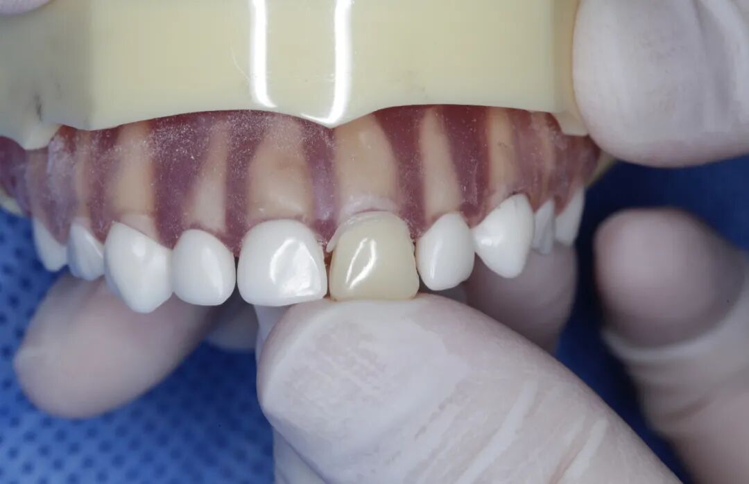 乳前牙透明冠的操作过程及技术要点