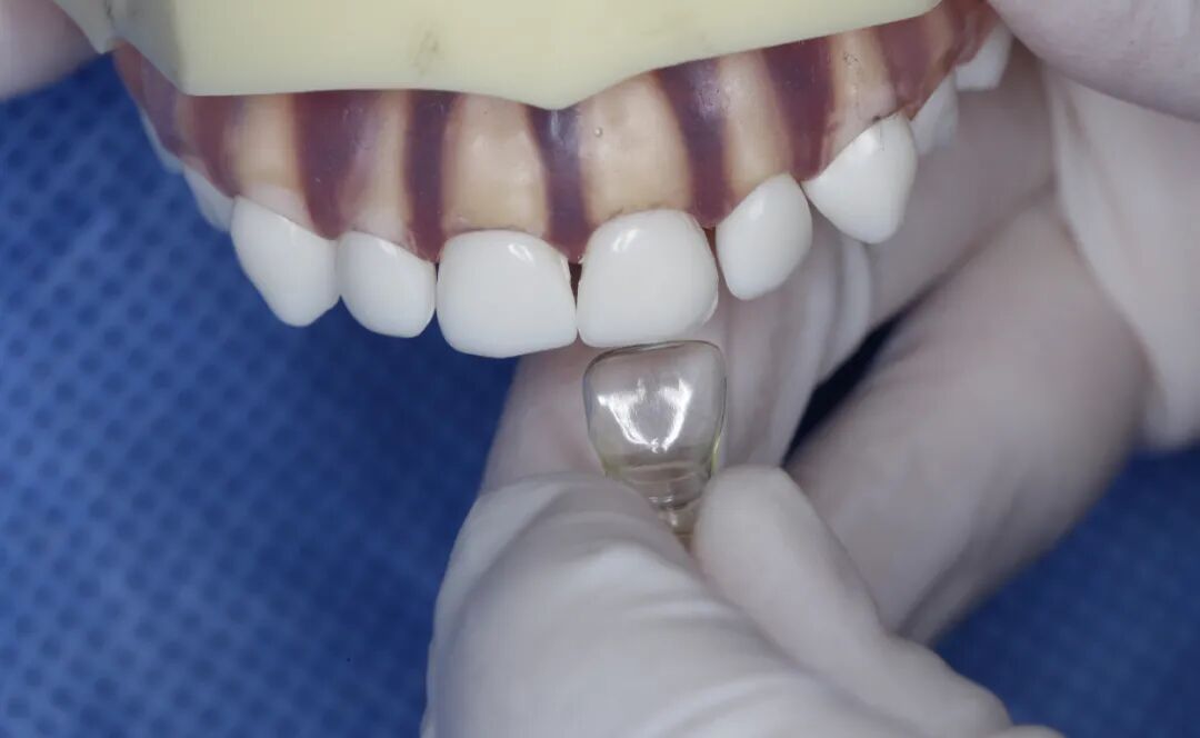 乳前牙透明冠的操作过程及技术要点