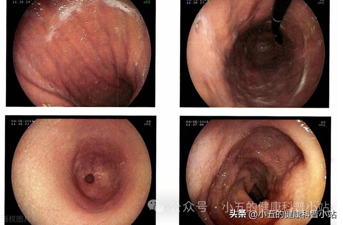 马来酸曲美布汀片可以吃多久