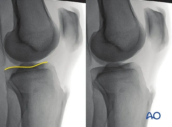 胫骨平台术中如何透视标准？内外侧平台如何分别透视？看这篇AO指南！
