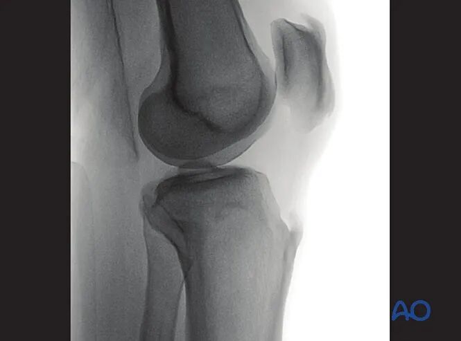 胫骨平台术中如何透视标准？内外侧平台如何分别透视？看这篇AO指南！