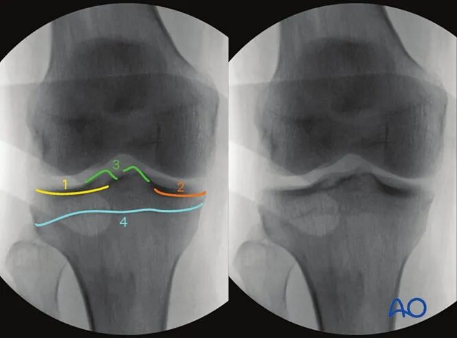 胫骨平台术中如何透视标准？内外侧平台如何分别透视？看这篇AO指南！