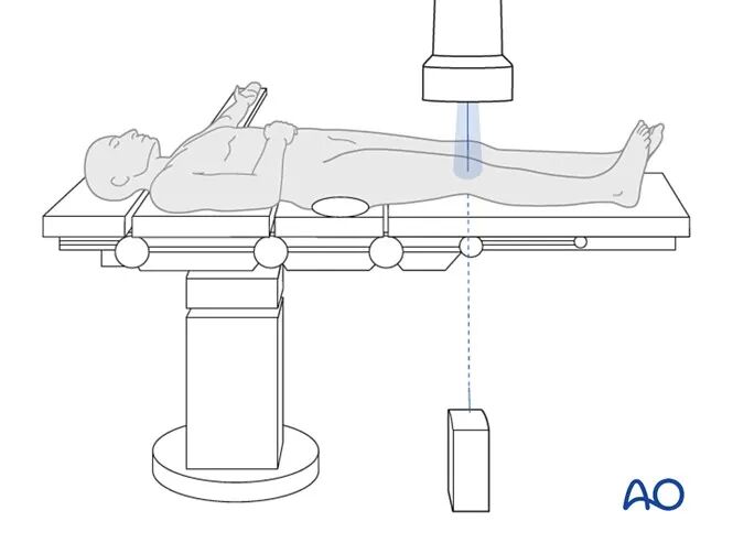 胫骨平台术中如何透视标准？内外侧平台如何分别透视？看这篇AO指南！