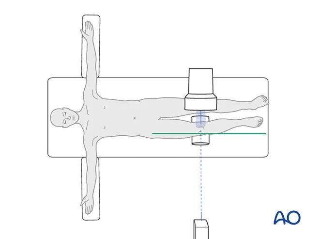 胫骨平台术中如何透视标准？内外侧平台如何分别透视？看这篇AO指南！