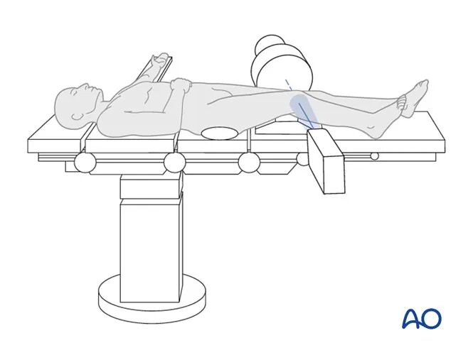 胫骨平台术中如何透视标准？内外侧平台如何分别透视？看这篇AO指南！