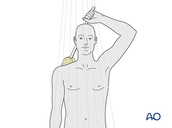 锁骨骨折的术后处理，看看AO怎么做