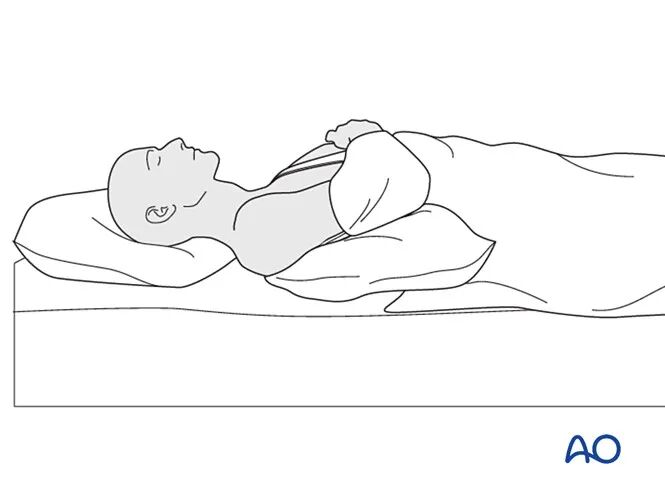 锁骨骨折的术后处理，看看AO怎么做