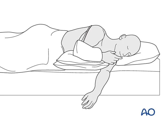 锁骨骨折的术后处理，看看AO怎么做