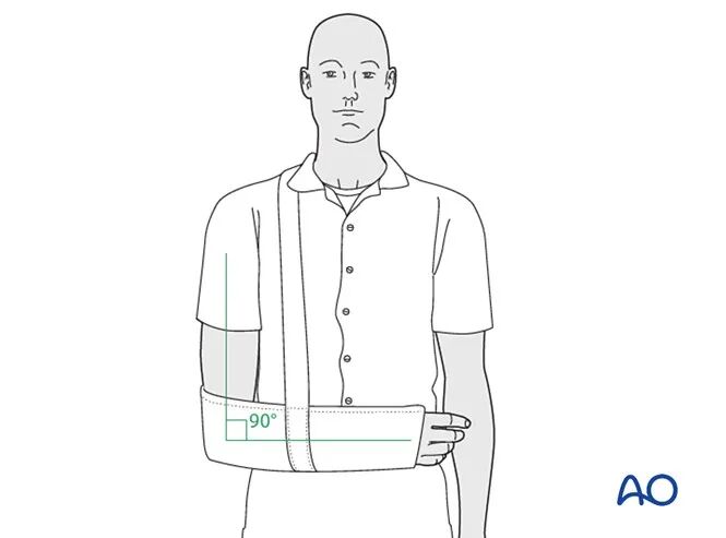锁骨骨折的术后处理，看看AO怎么做