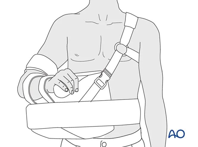 锁骨骨折的术后处理，看看AO怎么做