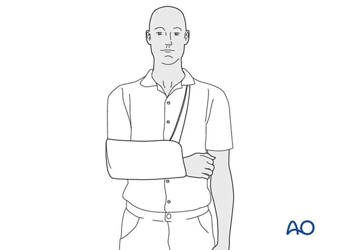 锁骨骨折的术后处理，看看AO怎么做