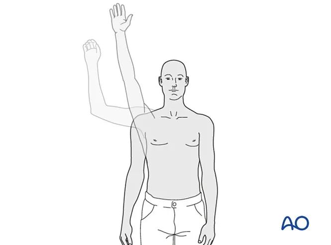 锁骨骨折的术后处理，看看AO怎么做