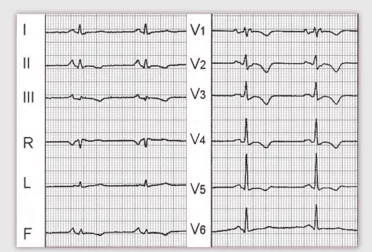 这些特征心电图改变，都是猝死的前兆
