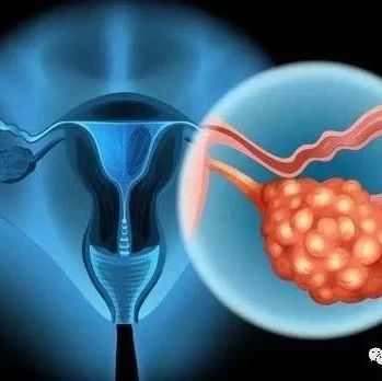 卵巢癌的4个重要早期信号，早点发现，还有机会治疗！【新民健康】