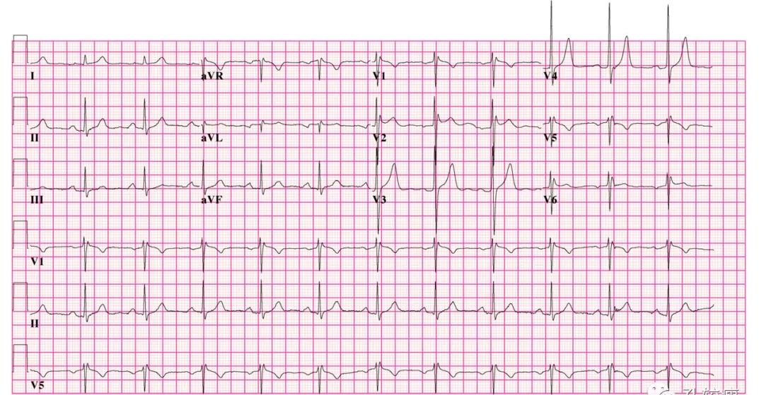这些特征心电图改变，都是猝死的前兆