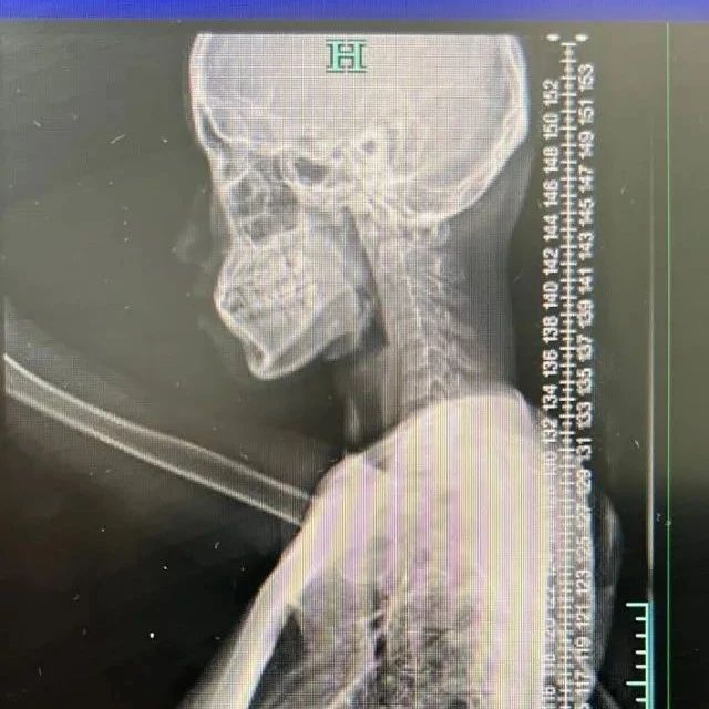频繁“落枕”后竟发展到双手麻木，21岁女孩查出病因悔不当初！这事也许你也常做