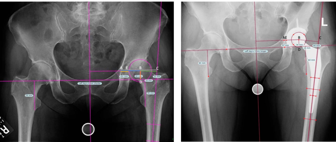 THA：旋转中心内移可降低近3倍臼杯松动风险