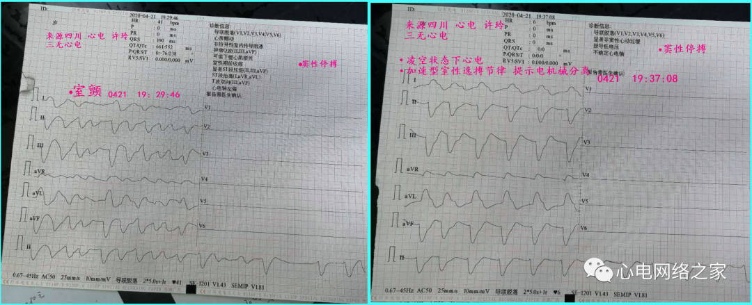 心电图如何报告死亡与濒死心电图​诊断