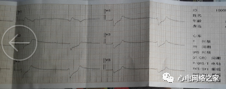 心电图如何报告死亡与濒死心电图​诊断