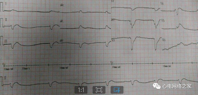 心电图如何报告死亡与濒死心电图​诊断