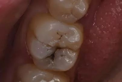 高效高质量的印章法补牙