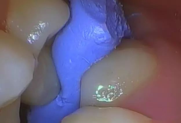 高效高质量的印章法补牙