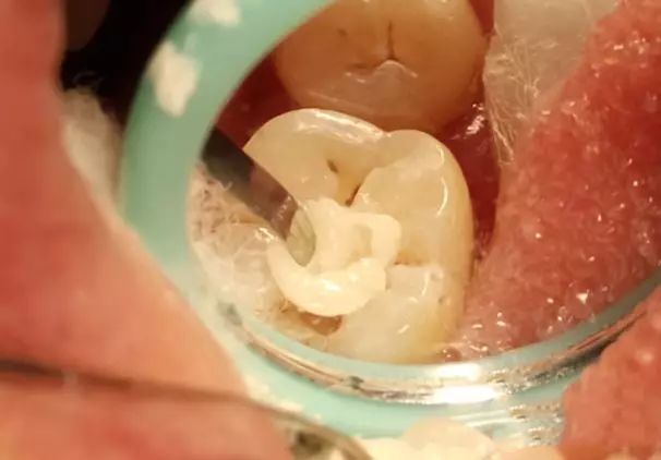 高效高质量的印章法补牙