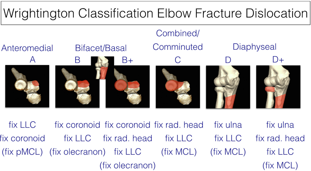 冠突骨折的解剖特点、分型与6种内侧手术入路